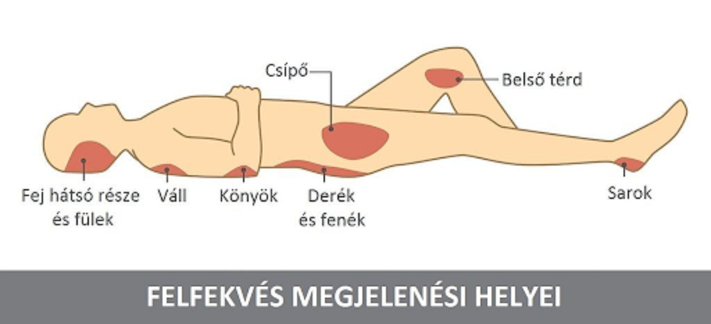 Dekubitusz kialakulásának helye